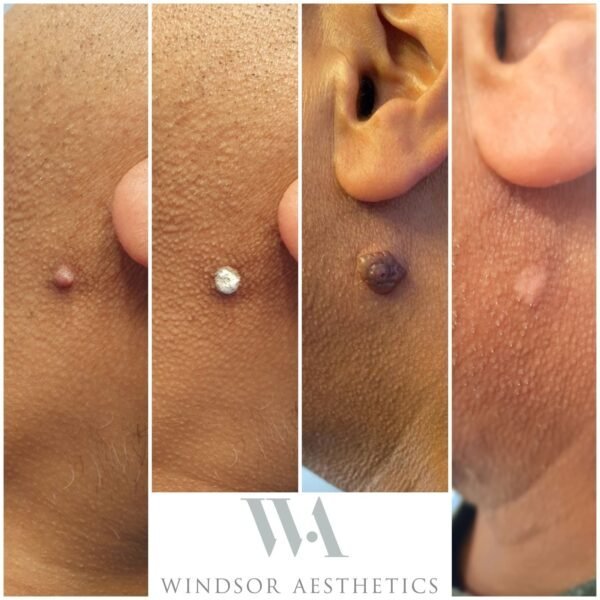 Cryotherapy treatment evolution